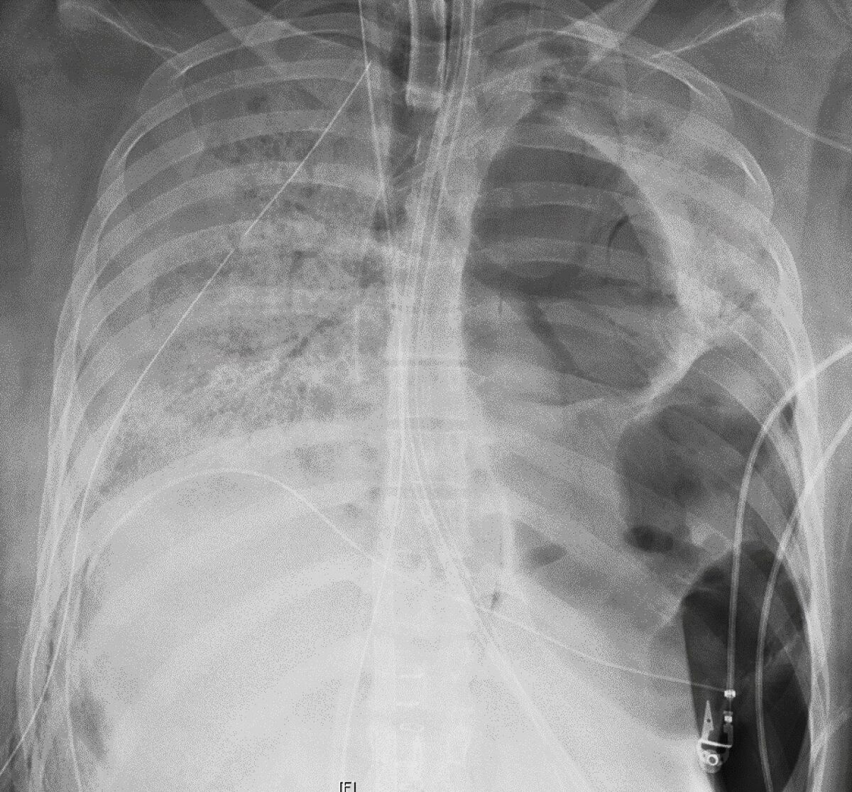 This X-ray image provided by Northwestern Medicine in June 2020 shows the chest of a COVID-19 patient.