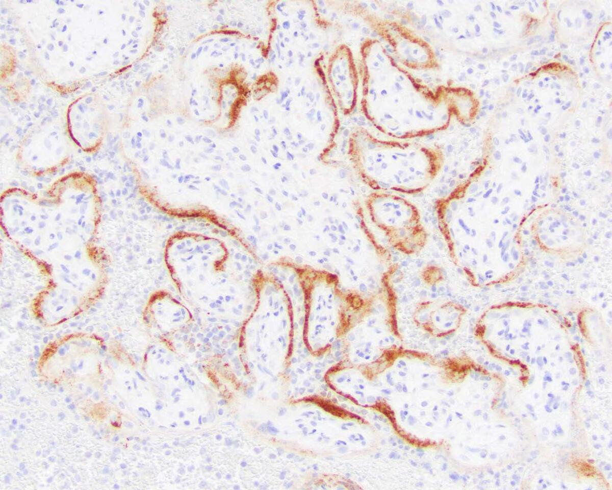 This microscope image shows placental cells from a stillbirth, with SARS-CoV-2 infection indicated by the darker stains. 