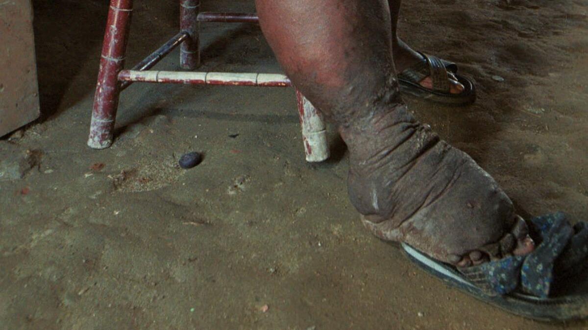 A severely disfigured foot of a woman suffering from elephantiasis in Santo Domingo, Domincan Republic.
