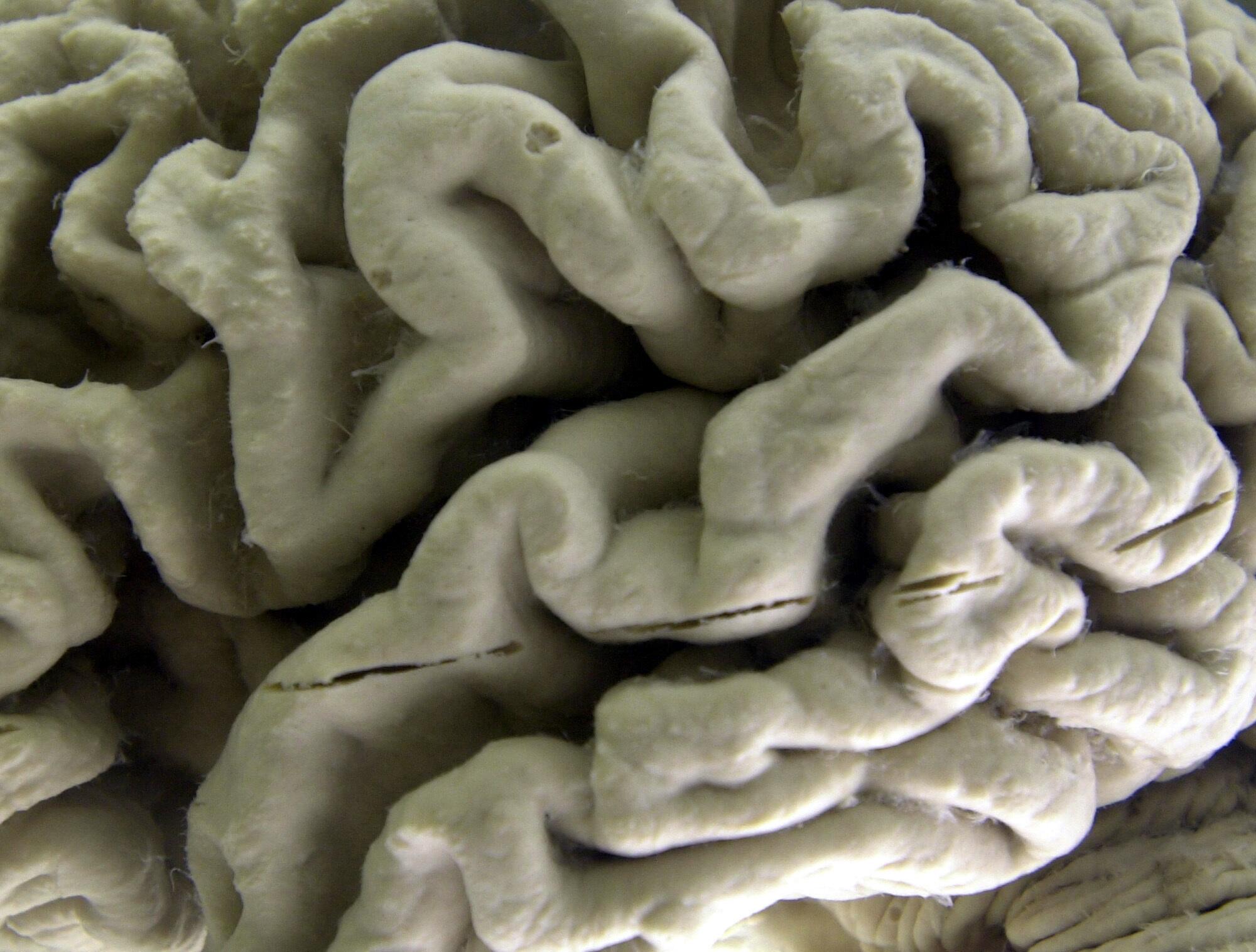 A closeup of a human brain affected by Alzheimer's disease is on display at the Museum of Neuroanatomy in Buffalo, N.Y.