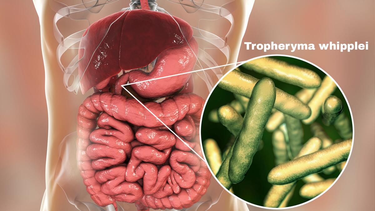 Tropheryma whipplei bacteria in human duodenum, the causative organism of Whipple's disease.