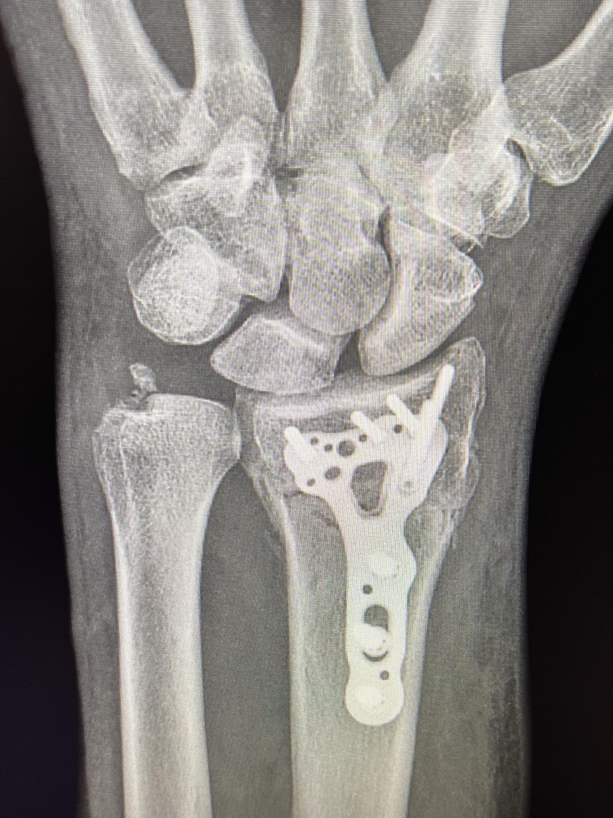 An X-ray shows a titanium plate and screws in the left wrist of Tim Salmon after his accident.