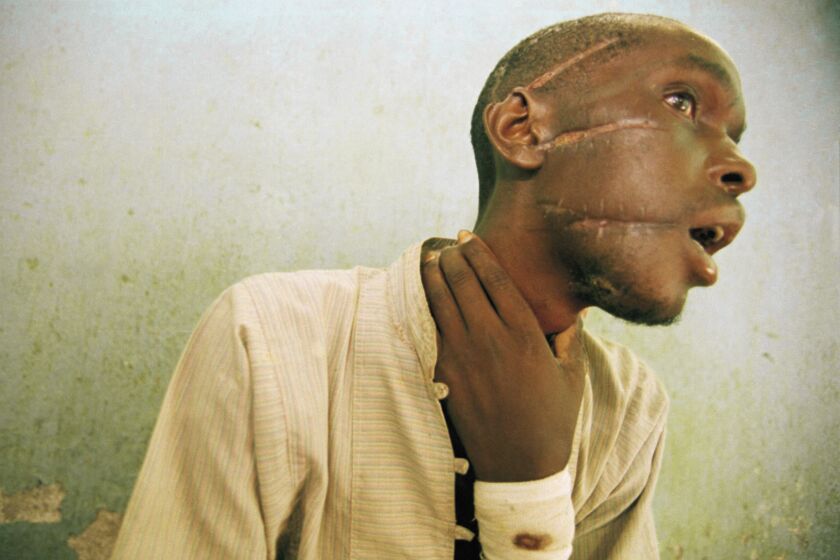 FILE - Nyabimana (first name unknown), 26, shows machete wounds at an International Committee of the Red Cross Hospital in Nyanza, some 35 miles southwest of Kigali, Rwanda, on June 4, 1994. A frail 87-year-old Rwandan, Félicien Kabuga, accused of encouraging and bankrolling the 1994 genocide in his home country goes on trial Thursday, Sept. 29, 2022, at a United Nations tribunal, nearly three decades after the 100-day massacre that left 800,000 dead. (AP Photo/Jean-Marc Bouju, File)
