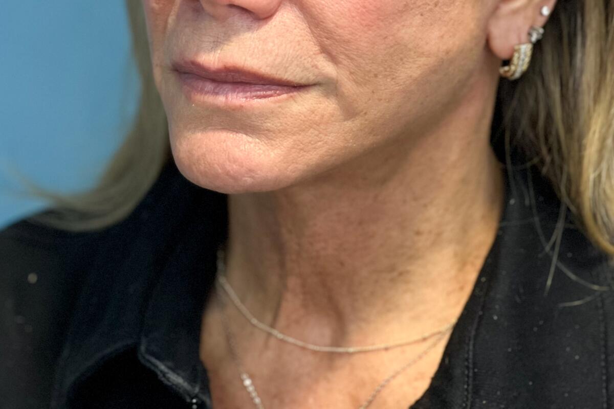 The $30,000 procedure fixed the drooping skin that the woman, a 57-year-old medical aesthetician, was left with after using Mounjaro to lose weight.