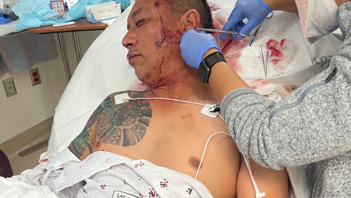 A nurse stiches up bloody wounds on a man's face