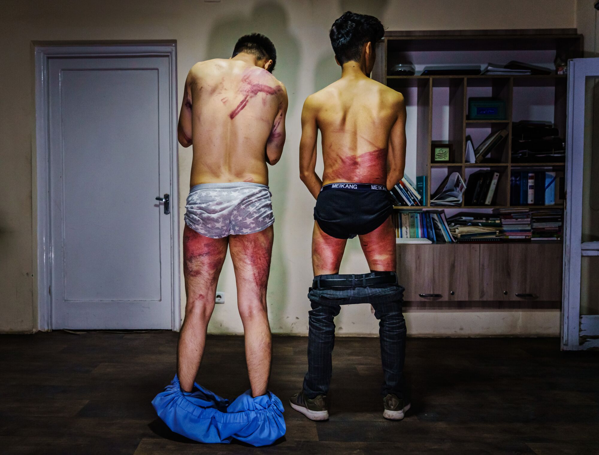Two men show their purple wounds on their backs and legs