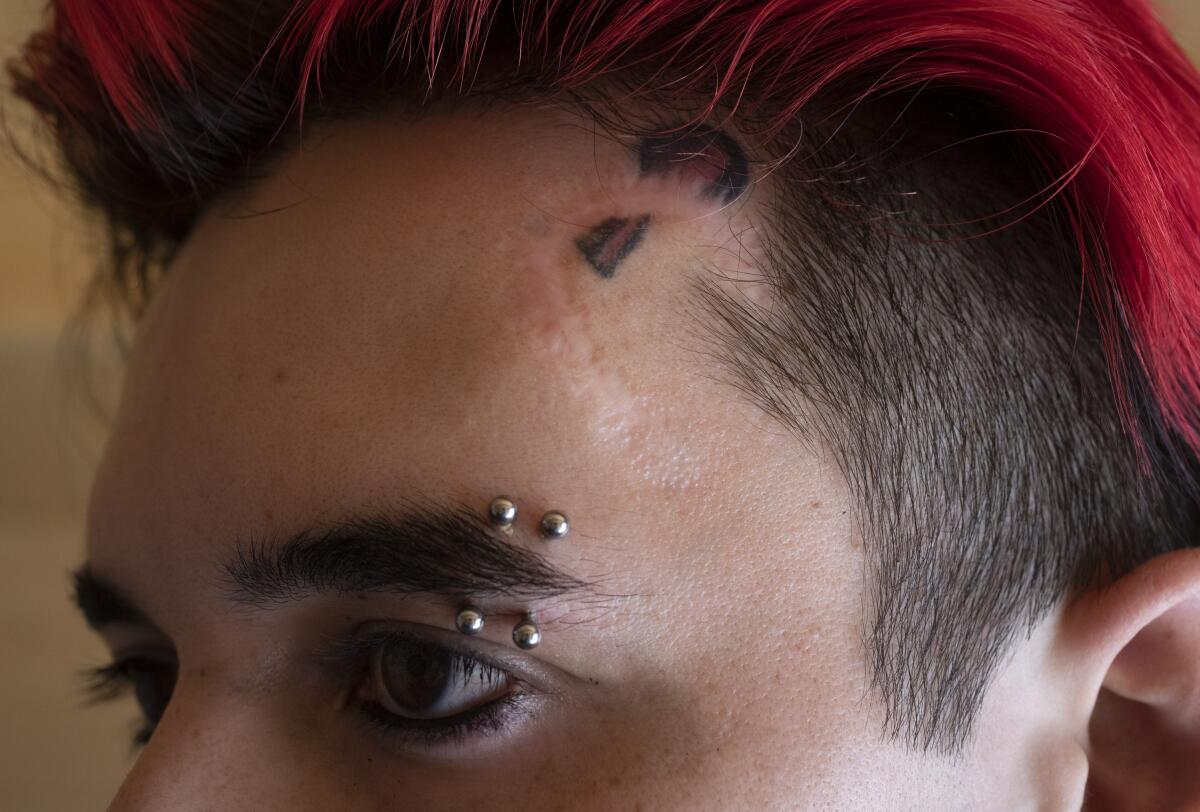 A half-circle scar on a man's forehead