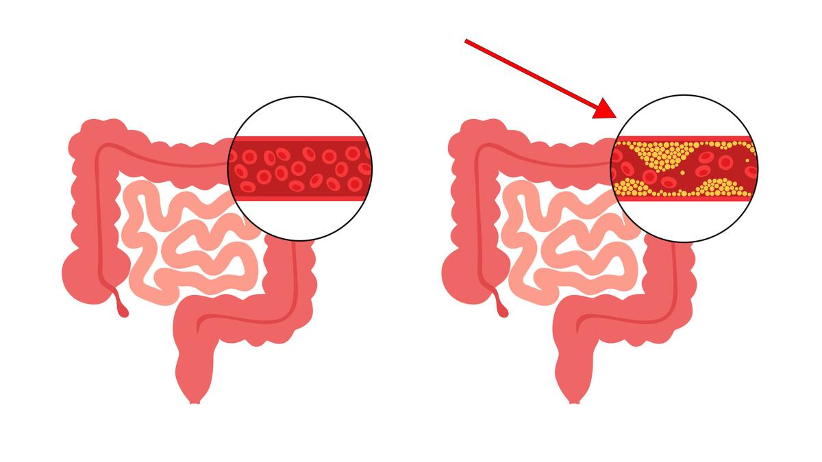 Blood flow to the large intestine is reduced and the colon wall is inflamed