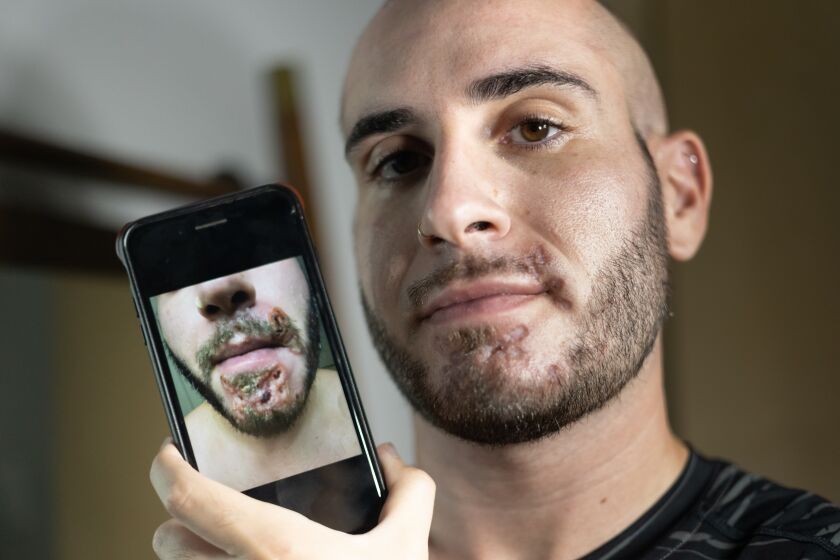 Joseph Cassara, 33, shows a photo taken on July 24 on Tuesday, Aug. 9, 2022 in Walnut Creek, Calif. He says this is the worst continuous pain he had ever felt in his life.