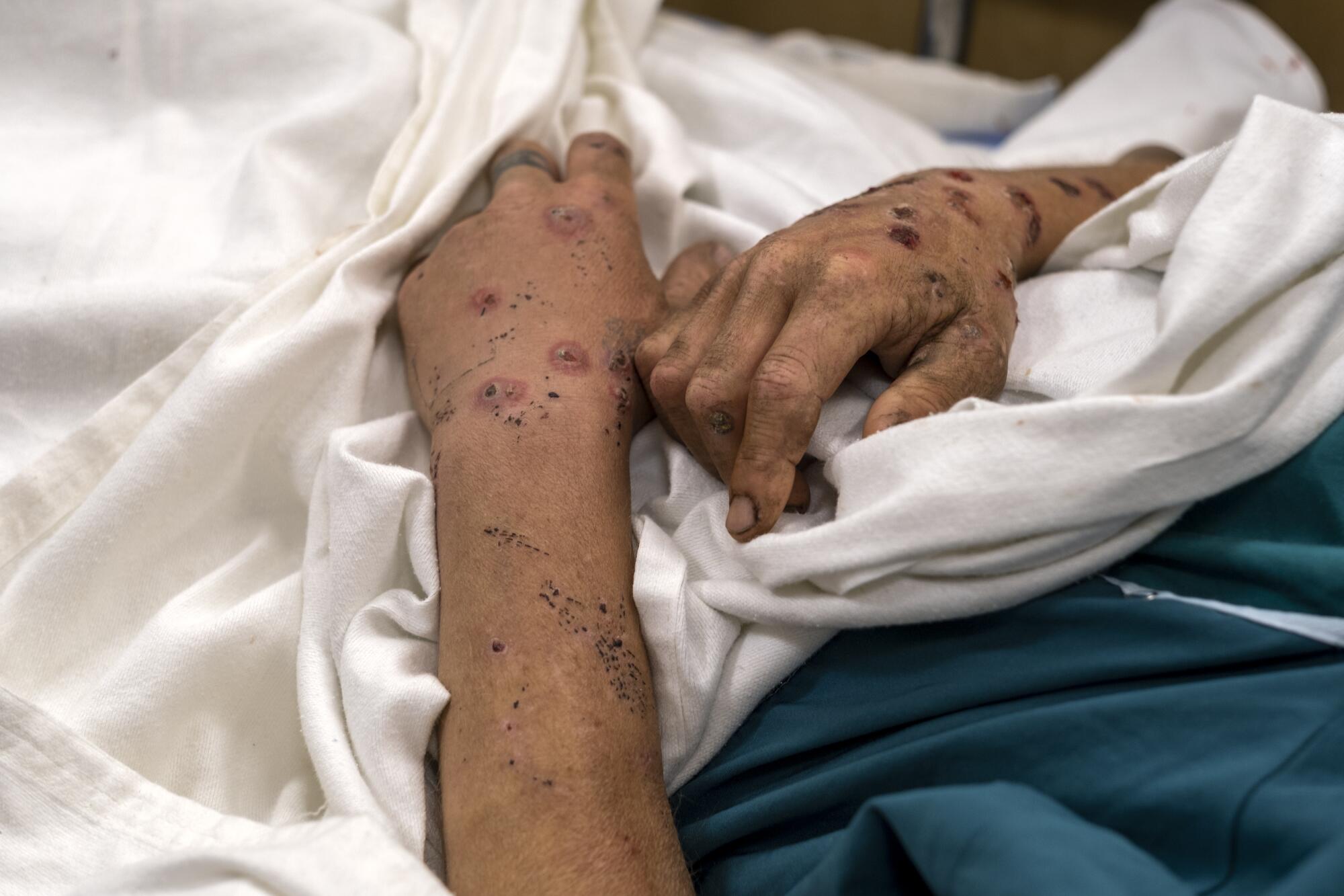 A hospital patient's hands are covered in sores.