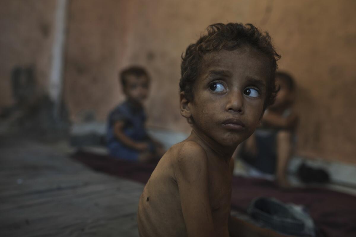 Josksar es Abu Abd, quien es el segundo hijo que sufre de desnutrición.