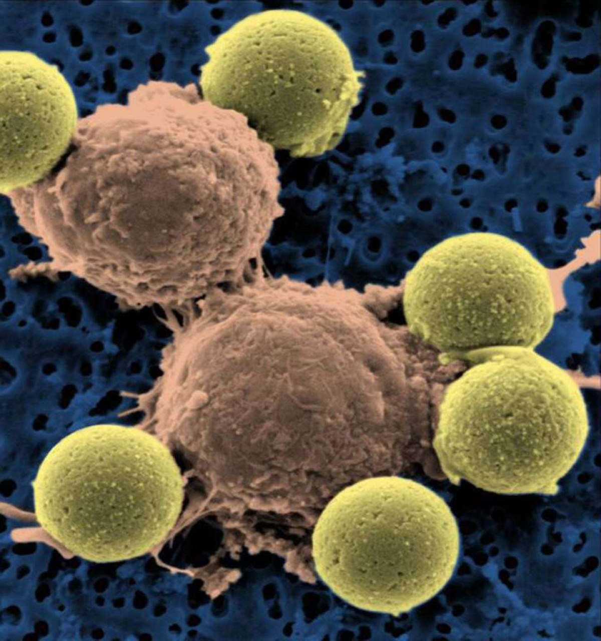 A microscope image shows the immune system cells called T cells binding to yellow beads, a process that causes the cells to divide. A new report on cancer research highlights recent efforts to harness the body's own immune system to fight cancer, which still kills more than half a million Americans every year.