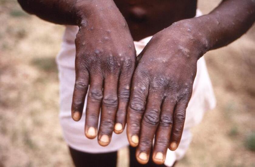 The hands of a monkeypox patient in the Democratic Republic of the Congo in 1997.
