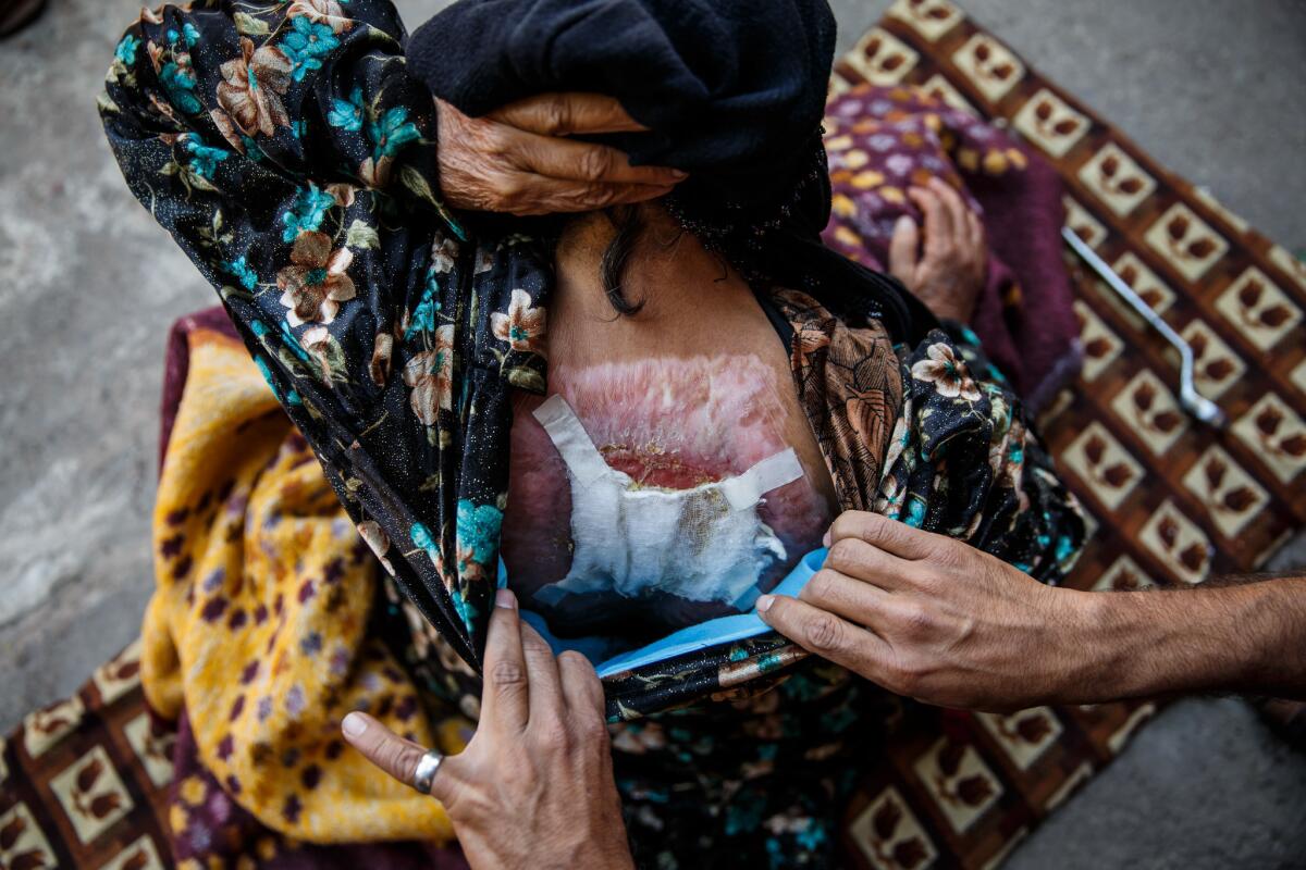 Zorha Hasan Ali, 63, shows burns she suffered during an airstrike in east Mosul on Nov. 17.