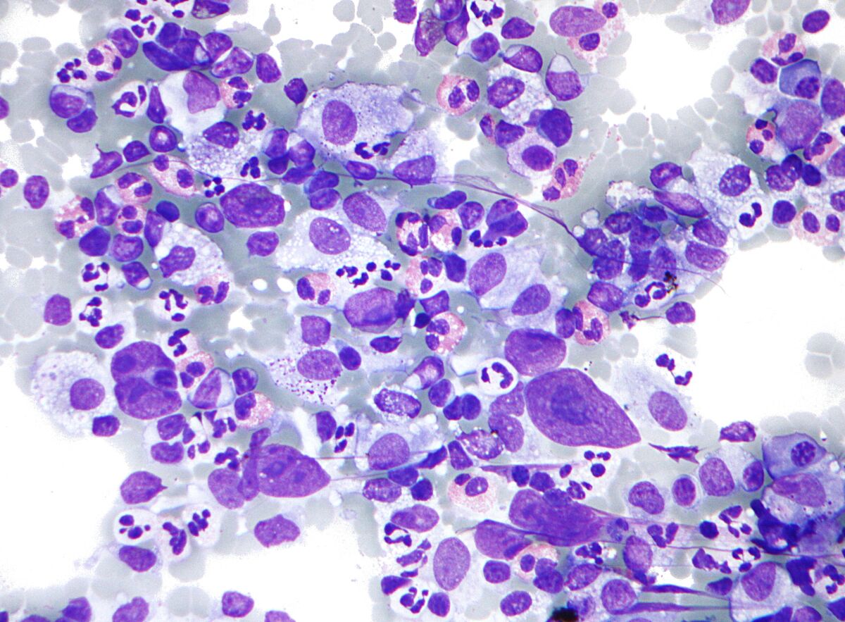 Hodgkin's lymphoma, one of a group of cancers that begin in infection-fighting cells of the immune system called lymphocytes.