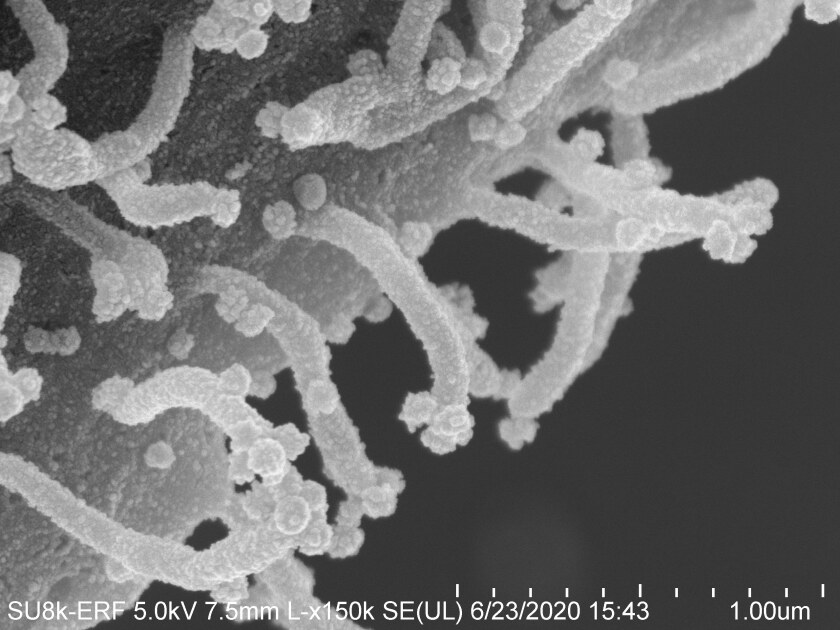 Otra célula infectada por el coronavirus.