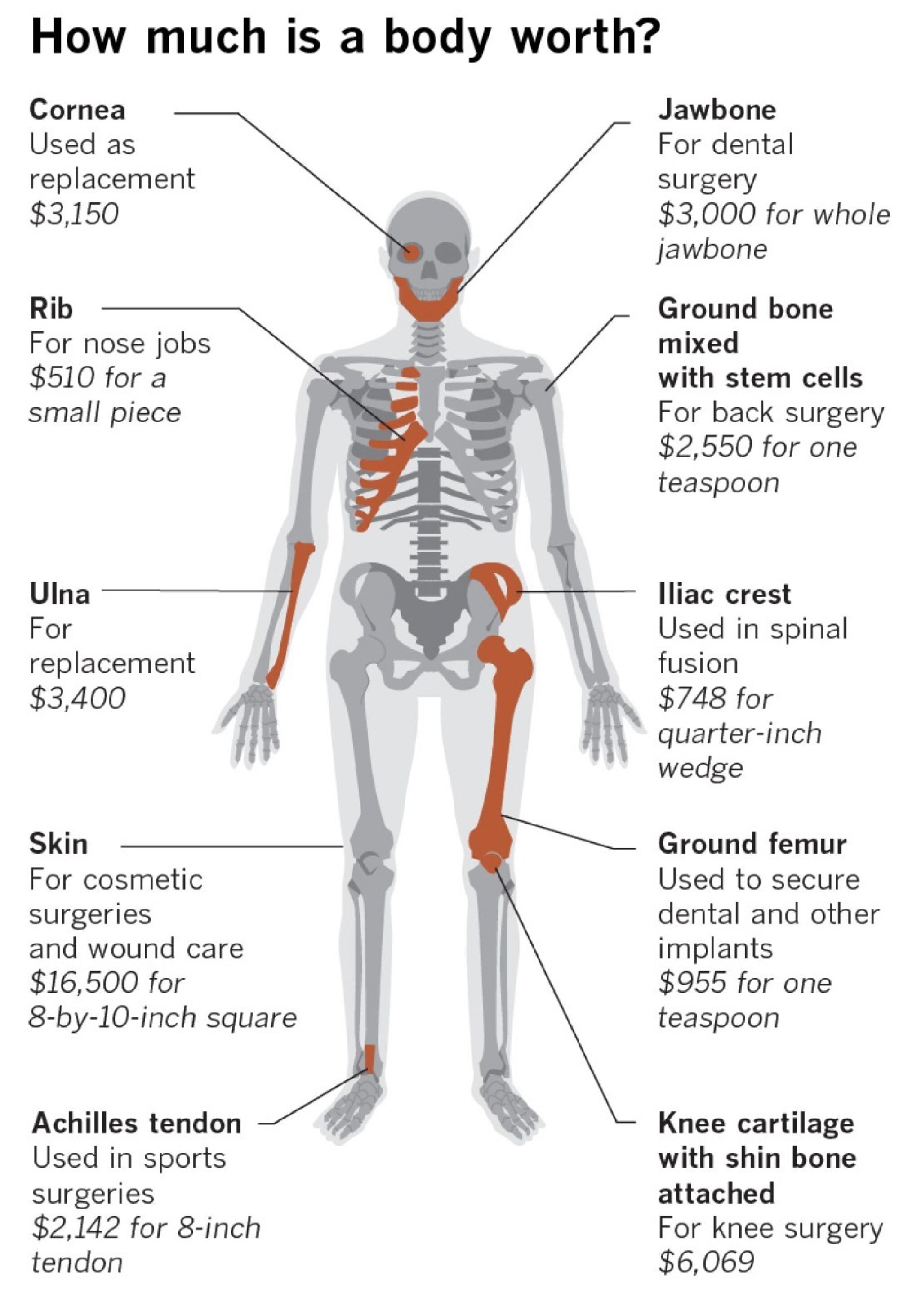 A human body can supply skin, bone and other tissues for medical products that biotech firms sell for hundreds of thousands of dollars to doctors and hospitals. Here are prices The Times found in a review of invoices received by hospitals. (A previous version of this illustration was sourced to Lifesharing. That organization was the source of the original image but not pricing data. Lifesharing does not sell body-tissue products.) Source: Times reporting