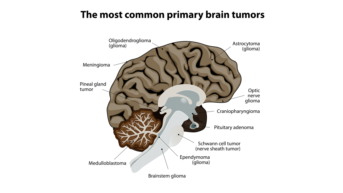 The most common primary brain tumors associated with the diseases.