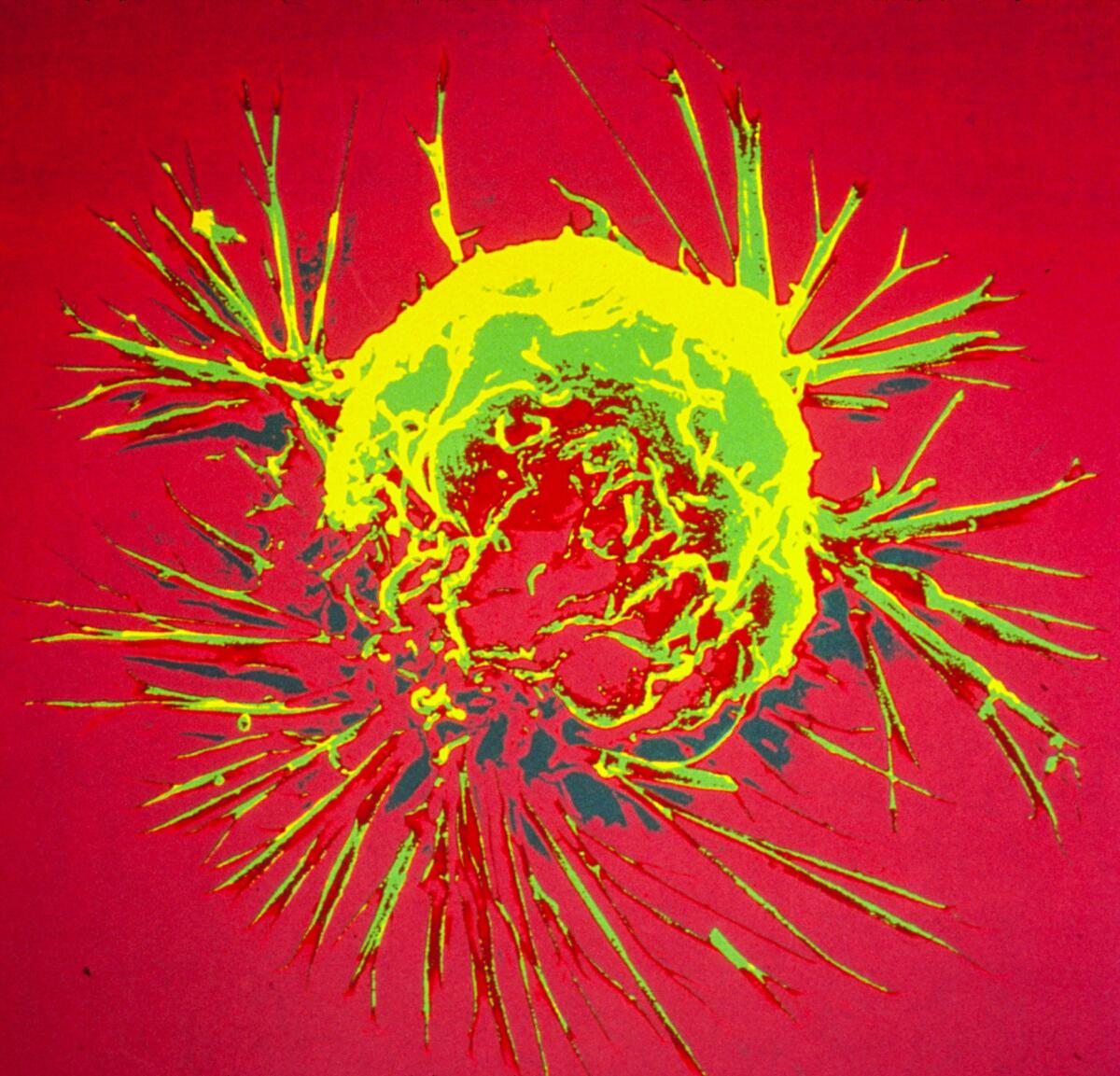 Research published Wednesday in the New England Journal of Medicine indicates that exposure to radiation during breast cancer treatment is linked to an increased risk of heart disease. Shown above is an electron microscope image of a breast cancer cell.