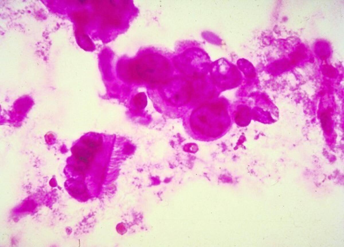 Detail of breast cancer cells.