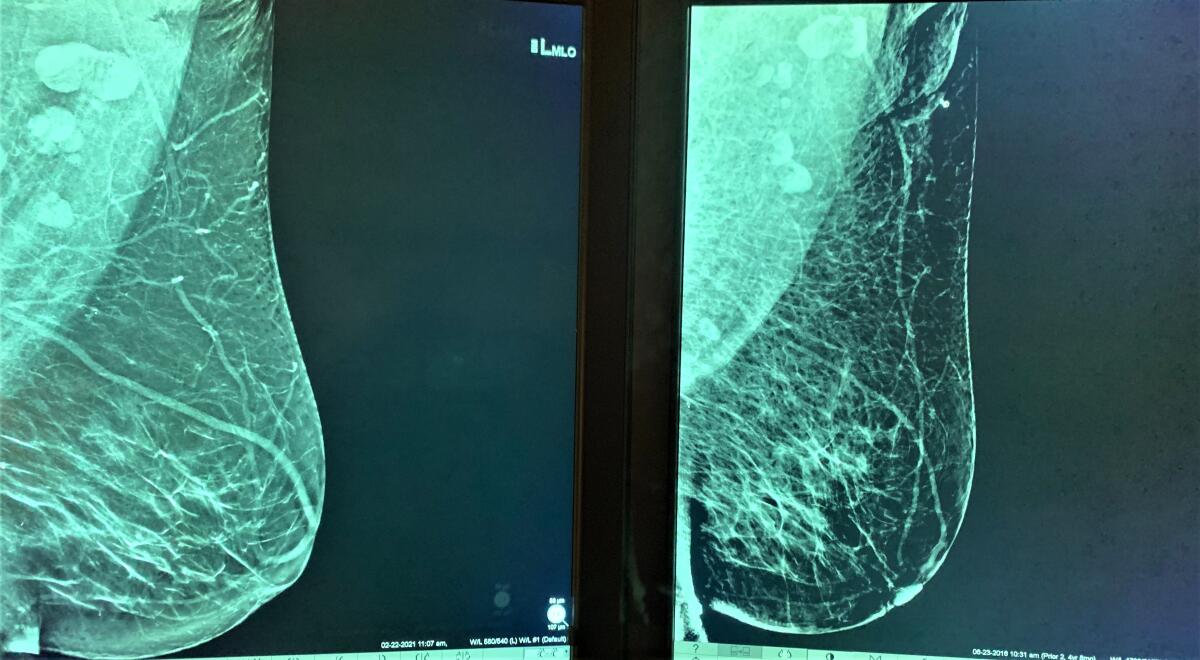 Two mammograms 