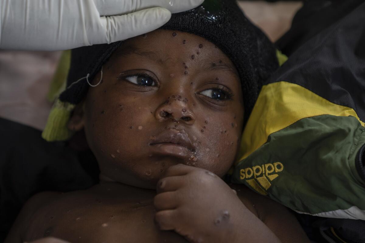 Emile Miango, 2, who has mpox, lies in the hospital.