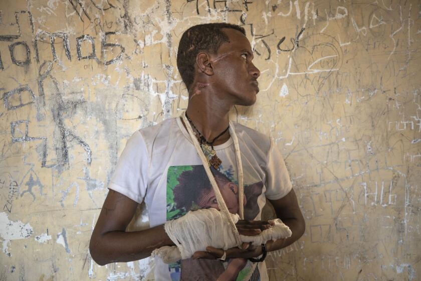 Abrahaley Minasbo a 22-year-old trained dancer and Tigrayan survivor from Mai-Kadra, Ethiopia, shows wounds on his face and his partially amputated hand, inside a shelter, in Hamdeyat Transition Center near the Sudan-Ethiopia border, eastern Sudan, Tuesday, Dec. 15, 2020. Minasbo said Amhara militia members dragged him from his home in Mai-Kadra on Nov. 9 and beat him in the street with a hammer, an axe, sticks and a machete, then left him for dead. Scars now slope across the right side of his face and neck. (AP Photo/Nariman El-Mofty)