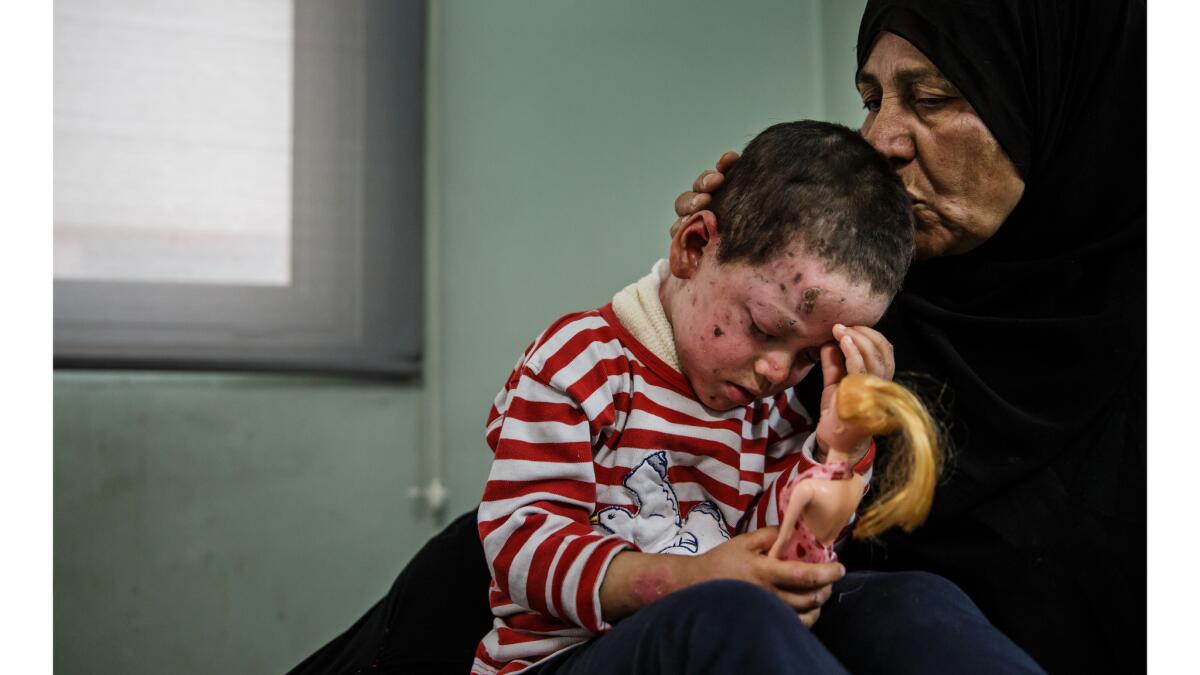 Alia Ali kisses her granddaughter Hawra Hassan, 4, who suffered shrapnel wounds on her face, neck and left eye, along with a broken foot from the March 17 U.S. airstrike on Mosul's Jadidah neighborhood.