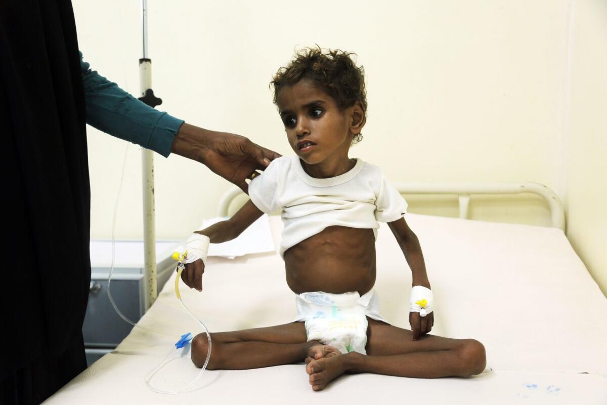 This photo taken on Nov. 05, 2017 shows a malnourished Yemeni child receiving treatment at a hospital in the Yemeni port city of Hodeidah. Humanitarian responders have this year provided direct aid to more than seven million Yemenis living on the brink of famine, according to the UN Office for the Coordination of Humanitarian Affairs.