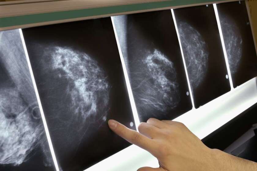 The Supreme Court is considering a patent case involving so-called breast cancer genes. Above, a mammogram X-ray.