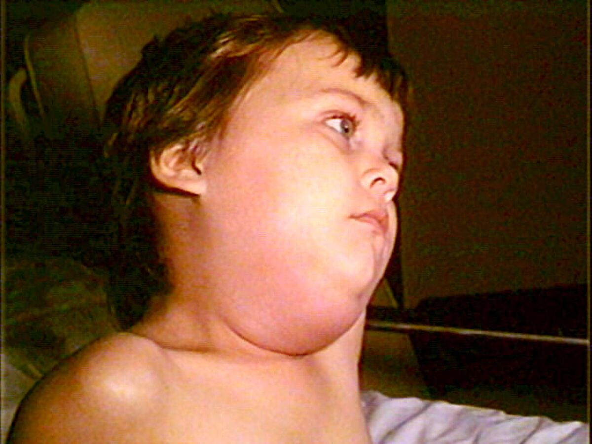 Mumps is best known for the puffy cheeks and tender, swollen jaw that it causes. This is a result of swollen salivary glands under the ears on one or both sides, often referred to as parotitis.
