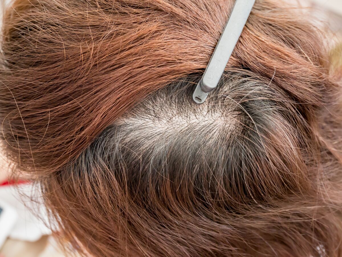 A woman's head with thinning hair.