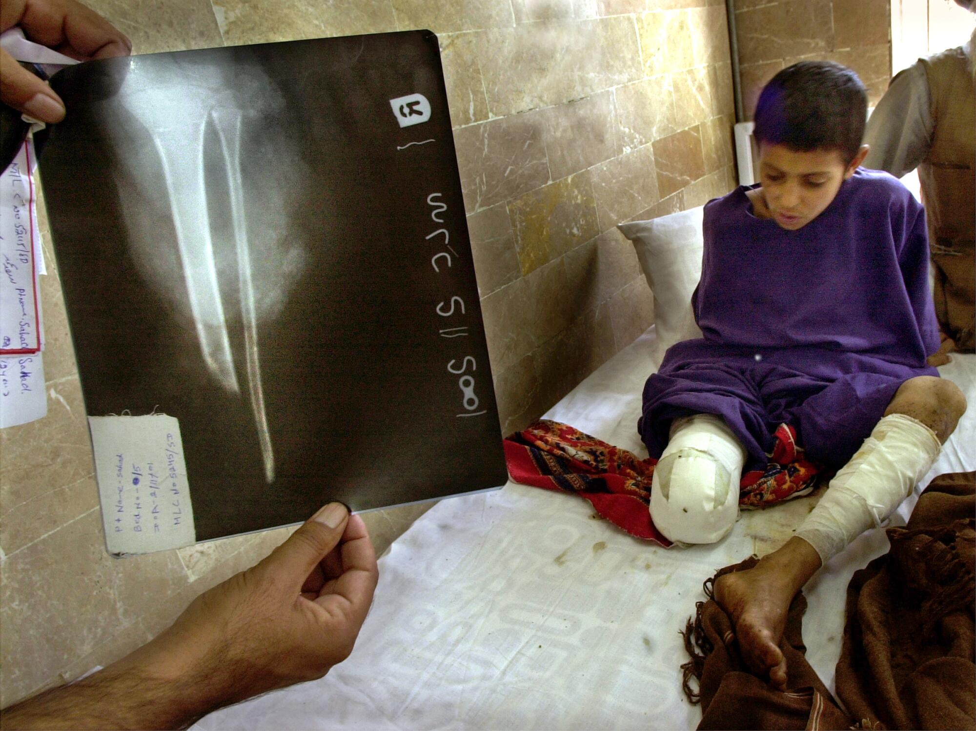 An X-ray shows the shattered leg of 10-year-old Sath Mohammad  on Nov. 6, 2001, in Quetta, Pakistan. 