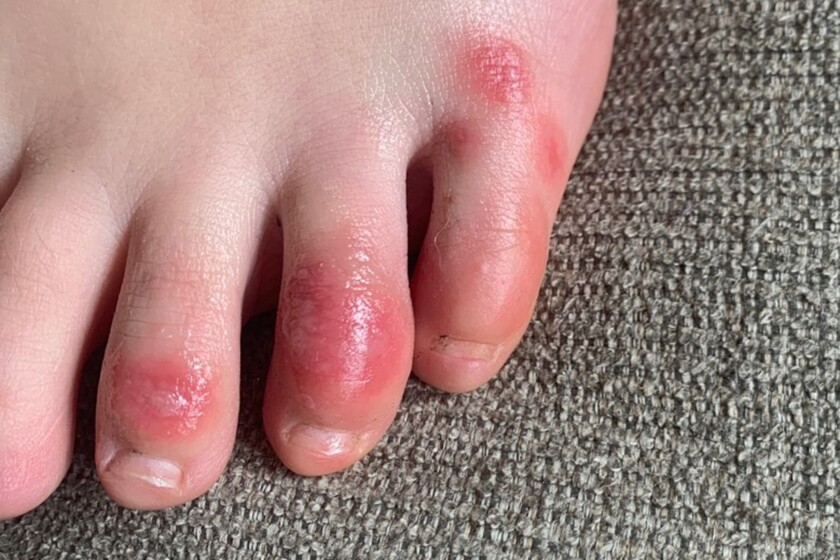 Virus Outbreak Skin Symptoms COVID Toes