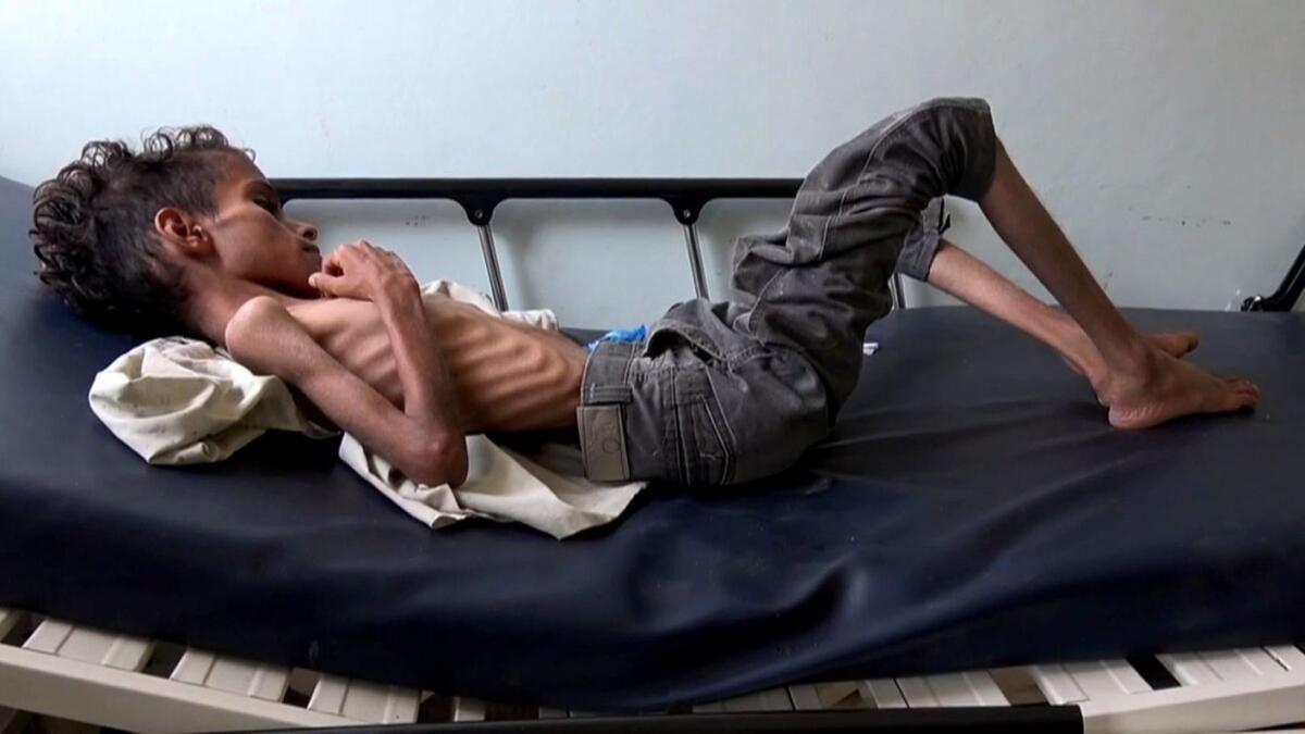 Ghazi Saleh, 10, at a hospital in Taiz, Yemen.