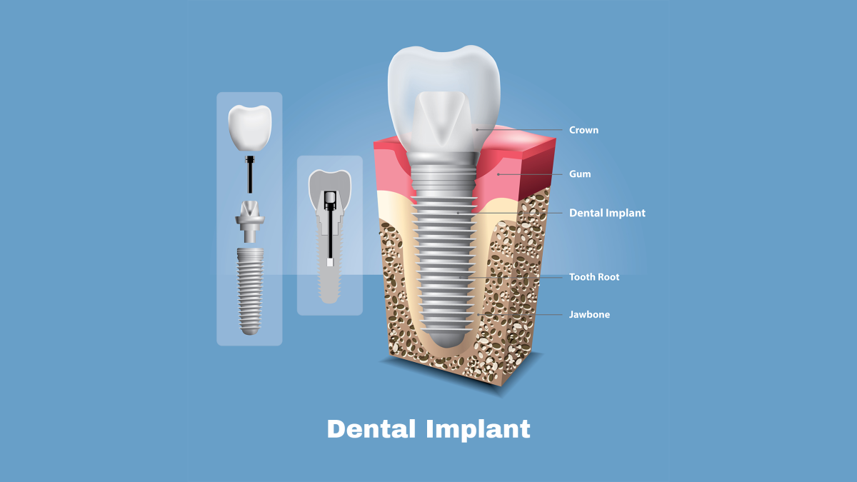 A Vector Illustration of Human teeth and Dental implant, and the parts the implant affects the missing tooth area.