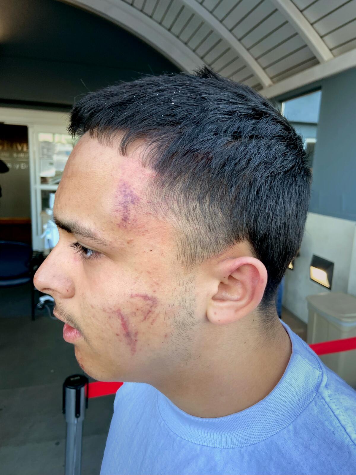 A profile of a teen boy with bruises on his cheek and forehead. 