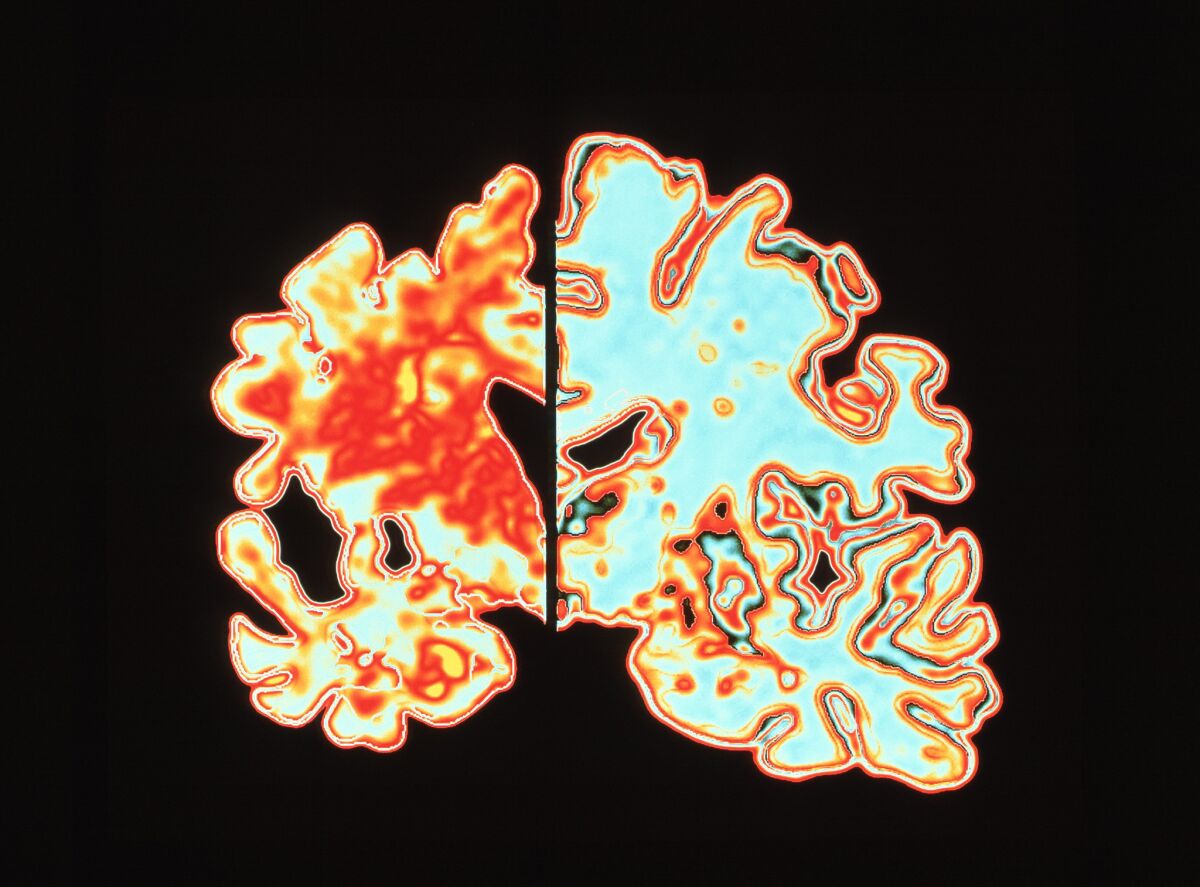 An ultrasound comparison of a brain of a patient with Alzheimer's disease, left, and a normal brain, right.