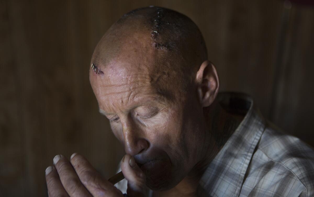 John Stephen Wood lights up a cigarette in the Ventura hotel room where he is recovering after being beaten and stabbed by attackers.
