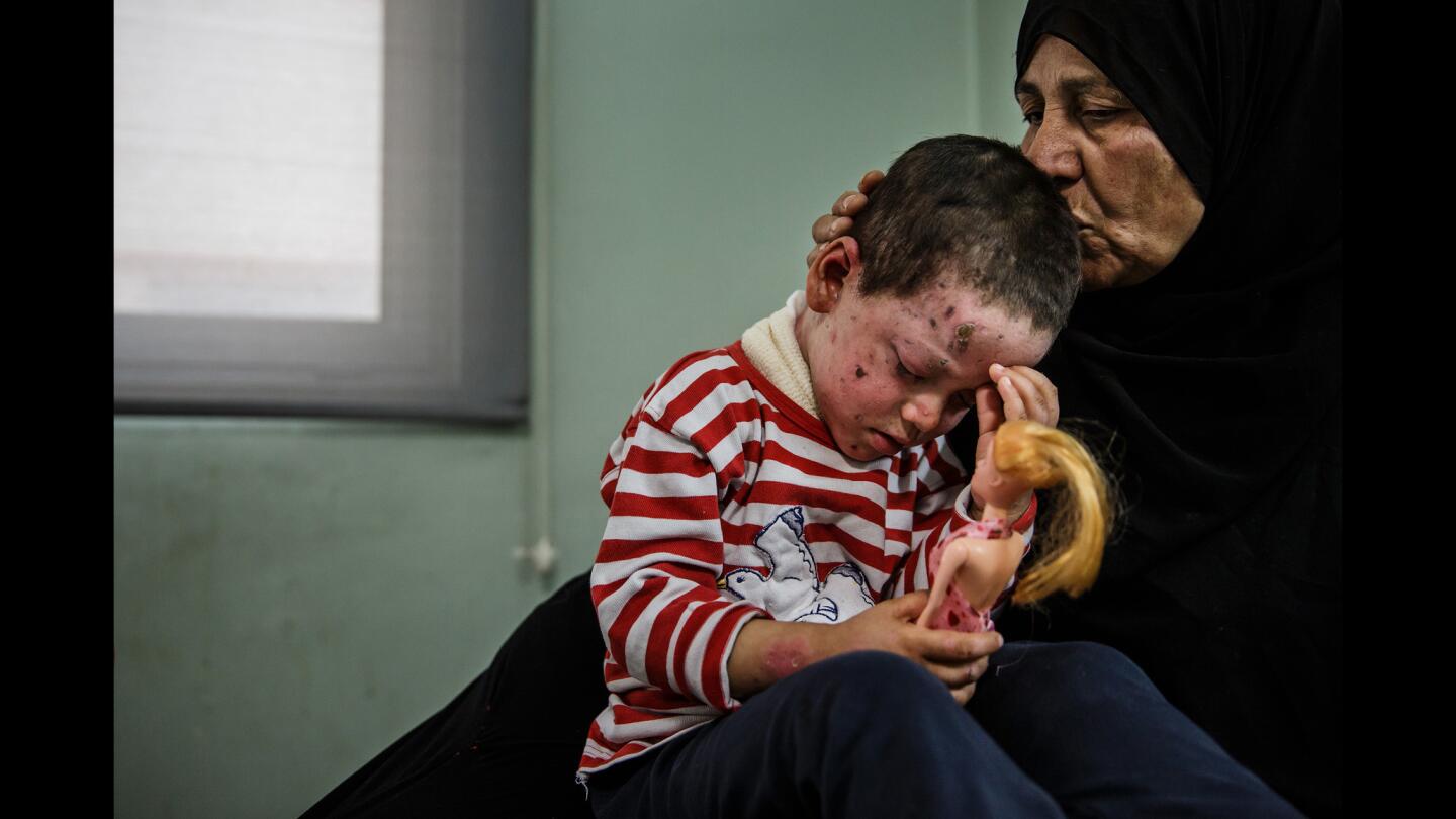 Alia Ali kisses her granddaughter Hawra Hassan, 4, who suffered shrapnel wounds on her face, neck and left eye, along with a broken foot from the March 17 U.S. airstrike on Mosul's Jadidah neighborhood.