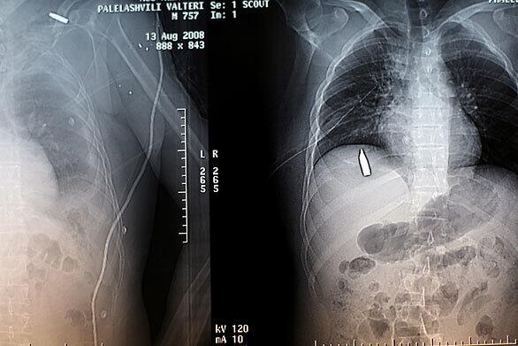 Tbilisi, Georgia: X-rays of injuries