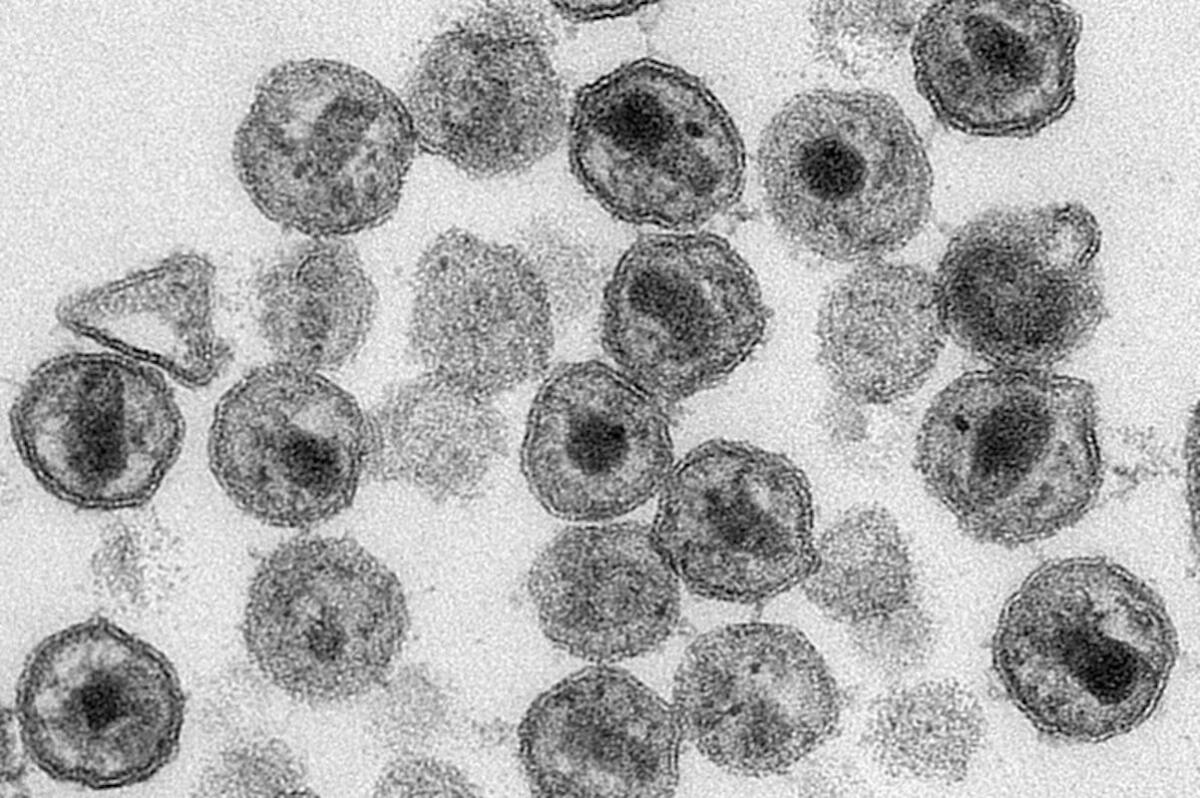 Esta imagen tomada con un microscopio electrónico y difundida por los Centros para el Control y la Prevención de Enfermedades de Estados Unidos (CDC, por sus siglas en inglés) muestra viriones del VIH.