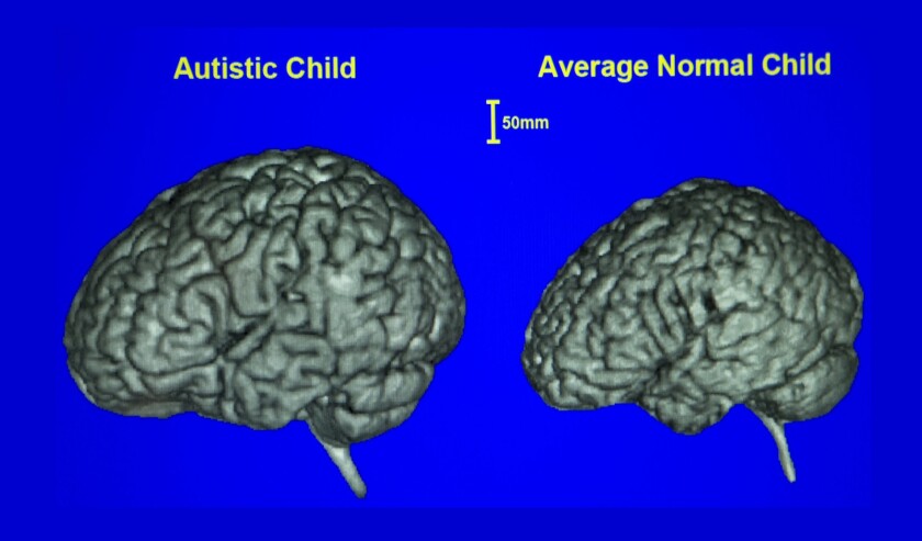 Ucsd Seeks Volunteers For Study That Will Try To Identify Risk Of Autism Before Symptoms Appear The San Diego Union Tribune