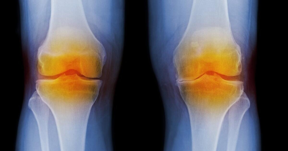 Study finds acetaminophen to be useless in relieving osteoarthritis pain