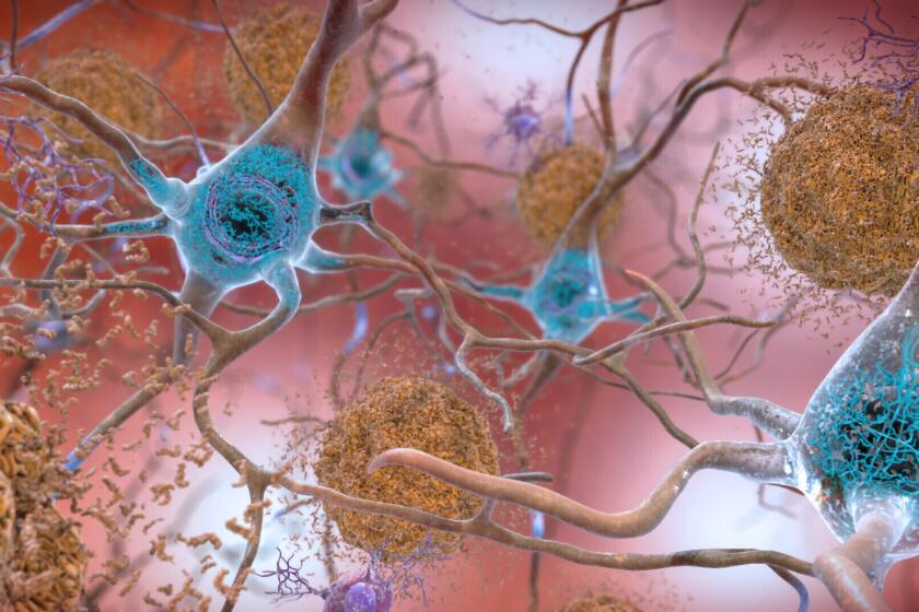This illustration made available by the National Institute on Aging/National Institutes of Health depicts cells in an Alzheimer’s affected brain, with abnormal levels of the beta-amyloid protein clumping together to form plaques, brown, that collect between neurons and disrupt cell function. Abnormal collections of the tau protein accumulate and form tangles, blue, within neurons, harming synaptic communication between nerve cells. An experimental Alzheimer’s drug modestly slowed the brain disease’s inevitable worsening, researchers reported Tuesday, Nov. 29, 2022 - and the next question is how much difference that might make in people’s lives. Japanese drugmaker Eisai and its U.S. partner Biogen had announced earlier this fall that the drug lecanemab appeared to work, a badly needed bright spot after repeated disappointments in the quest for better Alzheimer’s treatments. (National Institute on Aging, NIH via AP)