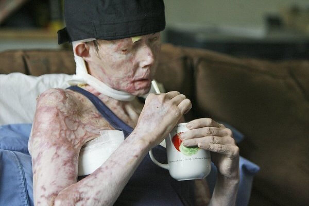 Carmen Tarleton is interviewed in her home in Thetford, Vt., in 2008. She received a face transplant this month.