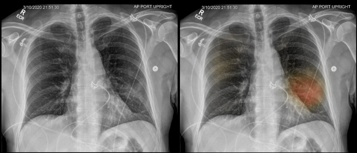 Two X-ray images show signs of lung damage that were identified by an artificial intelligence program. 