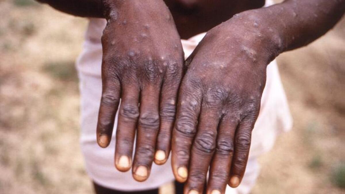 A California Man's 'Painful and Terrifying' Road to a Monkeypox Diagnosis -  California Healthline