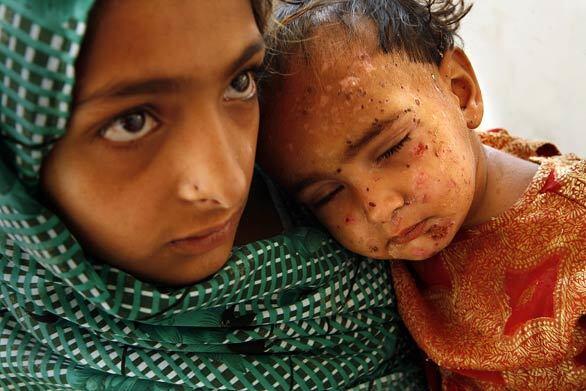 At the Mardan Medical Complex in northwest Pakistan, 7-year-old Sajida holds her sister, Baby Nimra, 18 months old, who was wounded in the crossfire between Pakistani military units and Taliban fighters in the Swat Valley.