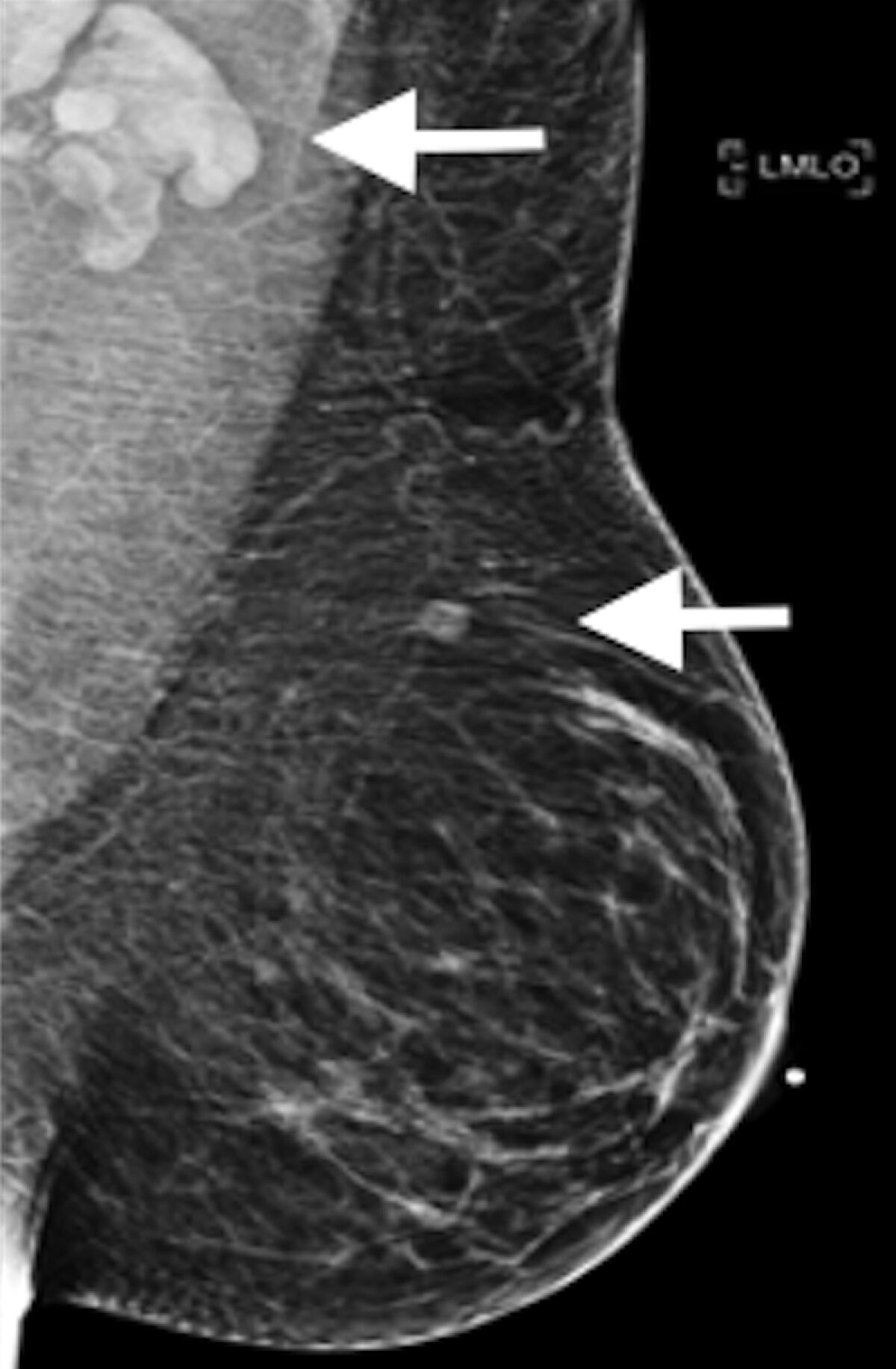 A mammogram with abnormally enlarged lymph nodes
